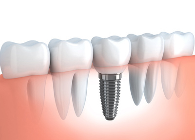 Zahnersatz Implantate